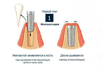 Первый этап при проведении классической имплантации