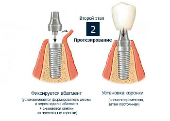 Второй этап (4-6 мес.спустя) классической имплантации