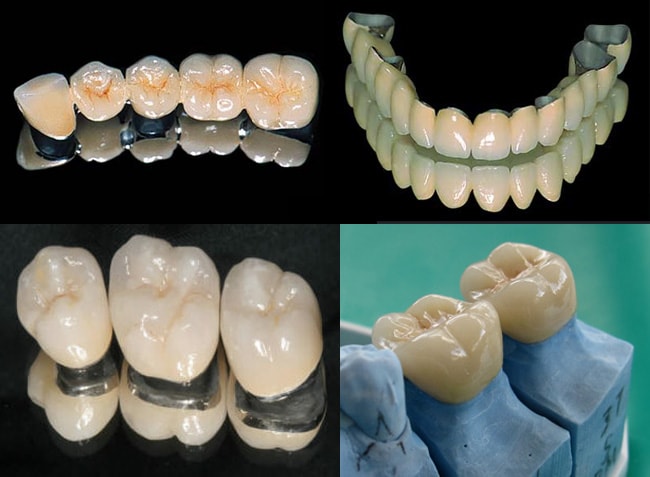 Металлокерамические коронки