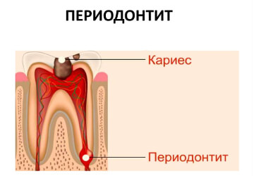 Эндодонтическая терапия при периодонтите