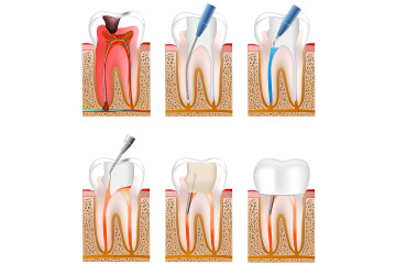 Эндодонтическое лечение пульпита