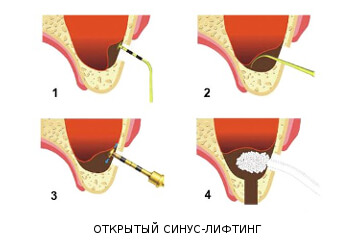 Процедура открытого синус-лифтинга