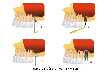 Операция закрытого синус лифтинга