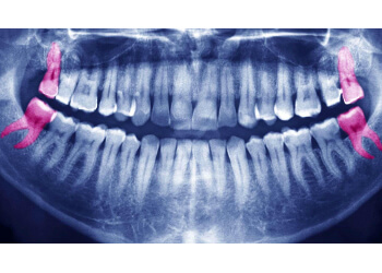 Расположение зубов мудрости на верхней и нижней челюсти
