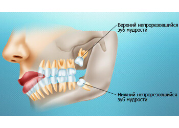 Удаление зуба мудрости любой сложности